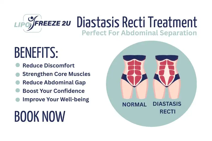 How Long Will It Take to See Improvements in Diastasis Recti Fareham