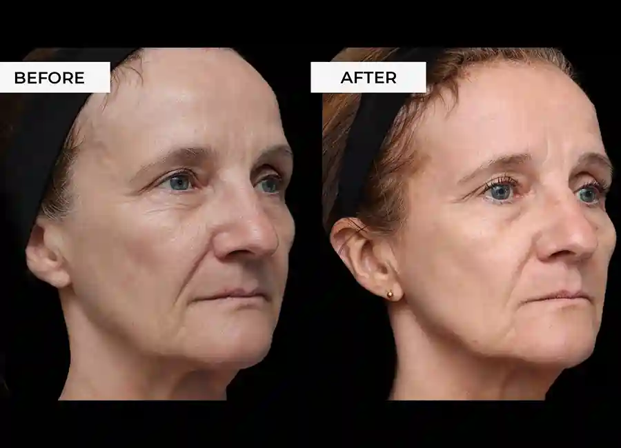 How Many RF Microneedling Sessions Will You Need to See a Difference Fareham?